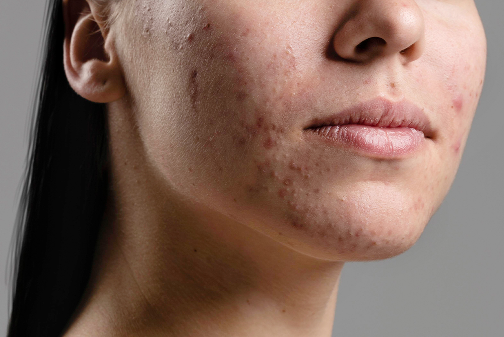 Acne and Blemishes